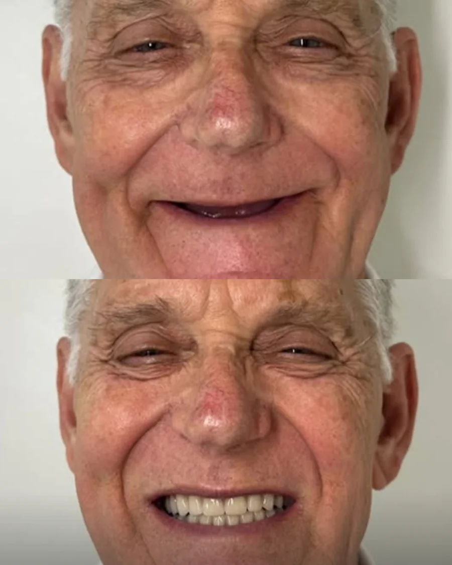 Paciente antes e depois da reabilitação do sorriso na Odonto Fortaleza