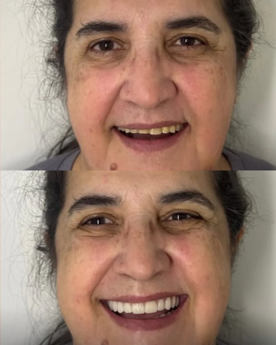 Antes e depois de paciente reabilitada com dentes fixos na Odonto Fortaleza