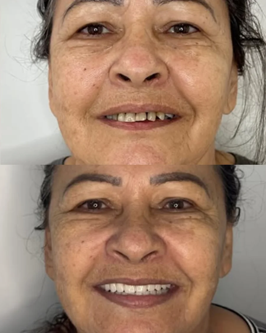 Paciente sorrindo após o tratamento com implantes na Odonto Fortaleza