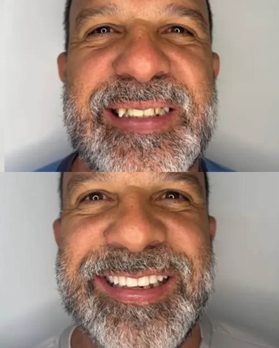 Resultado de prótese fixa sobre implantes em paciente da Odonto Fortaleza