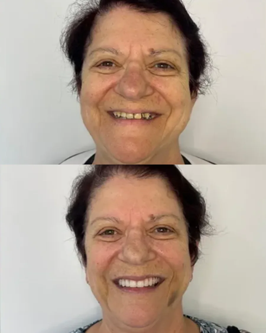Antes e depois da reabilitação oral de paciente da Odonto Fortaleza