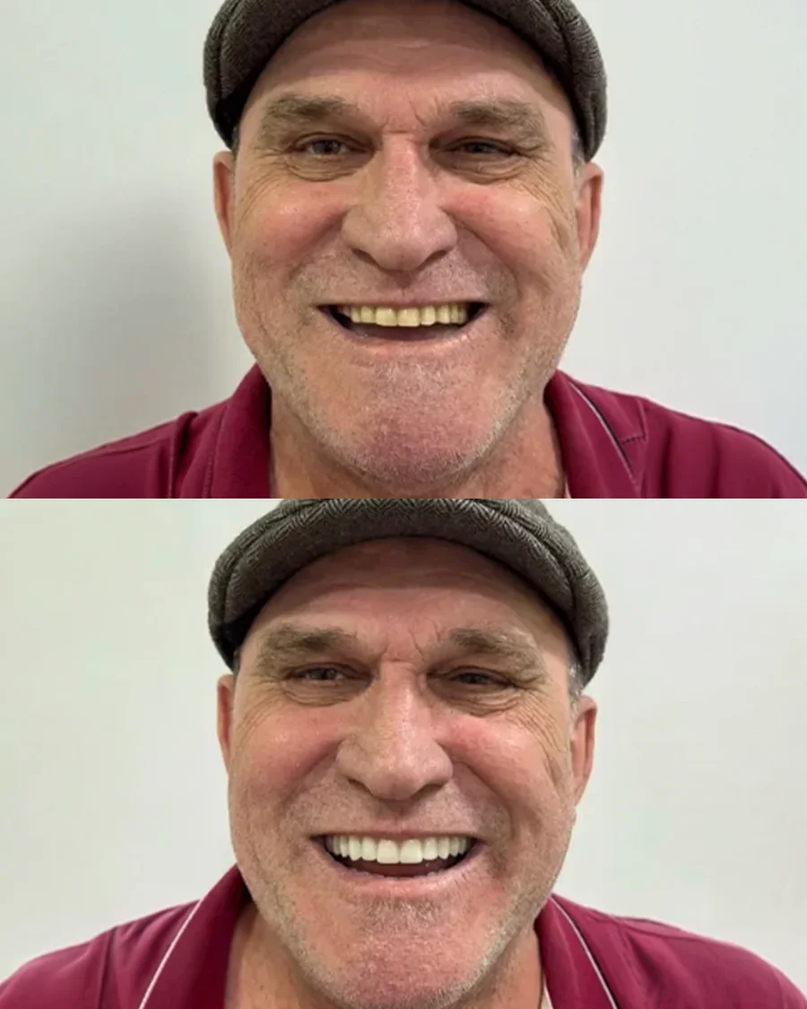 Paciente da Odonto Fortaleza com o sorriso reabilitado por dentes fixos