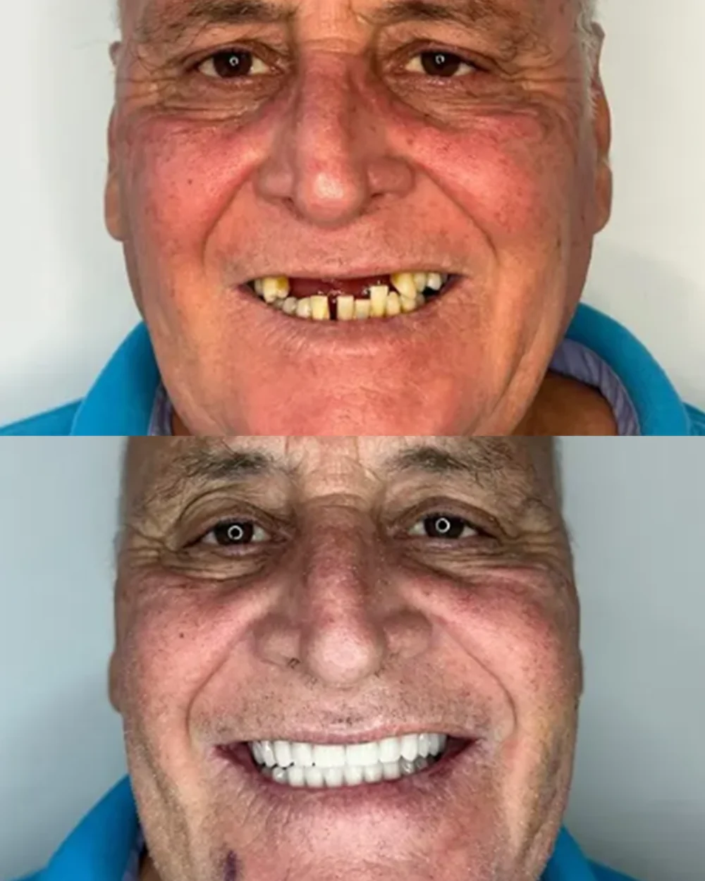 Paciente da Odonto Fortaleza antes e depois da reabilitação com dentes fixos